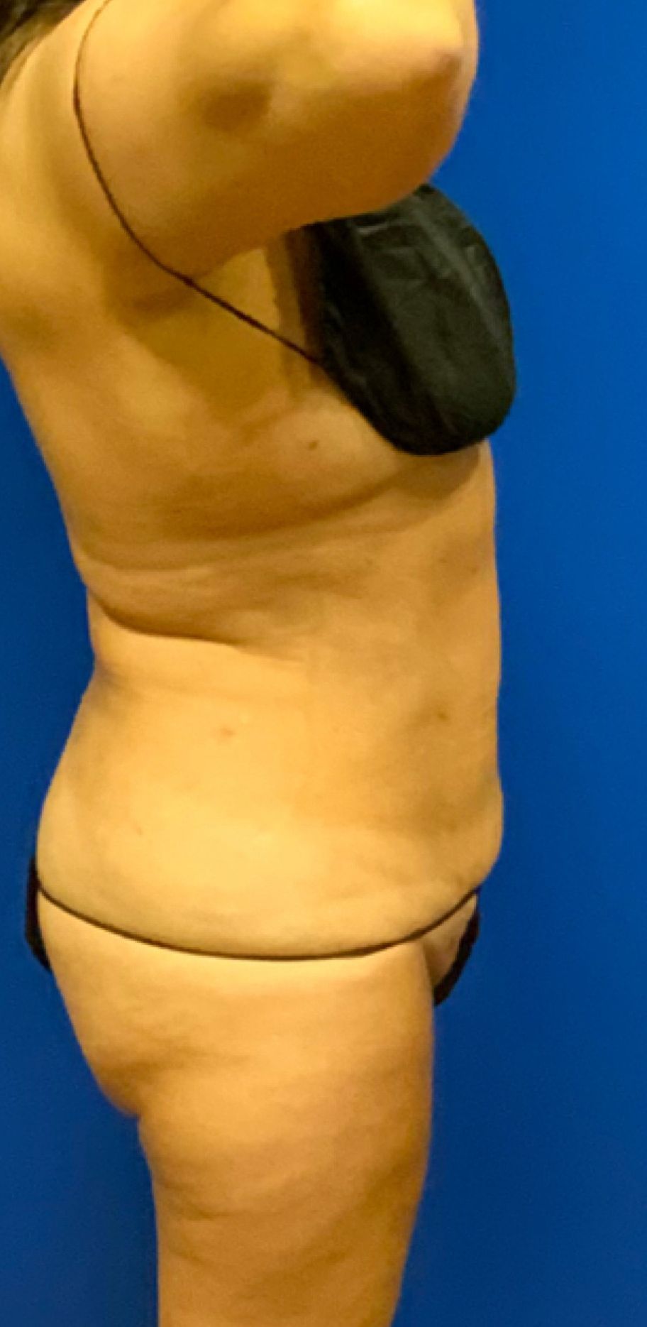 After Tummy Sculpting - Columbus, OH - Simply Sculpt