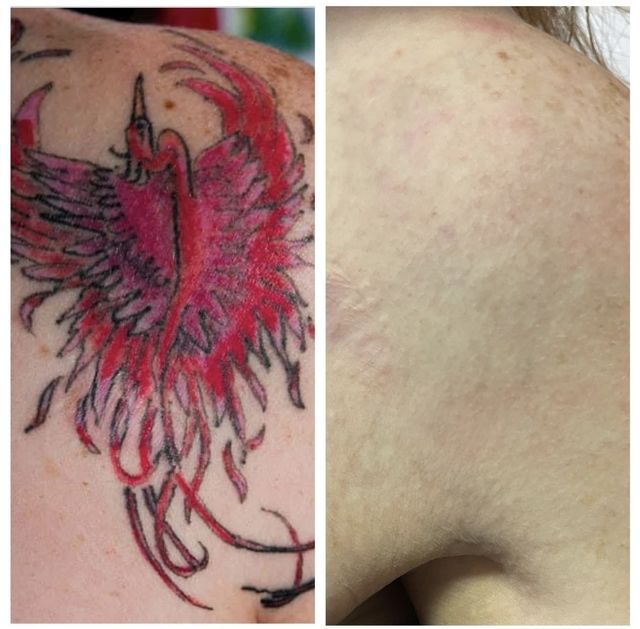 Lovely fade so far - The Missing Ink: Laser Tattoo Removal, Red Tattoo Ink  - valleyresorts.co.uk