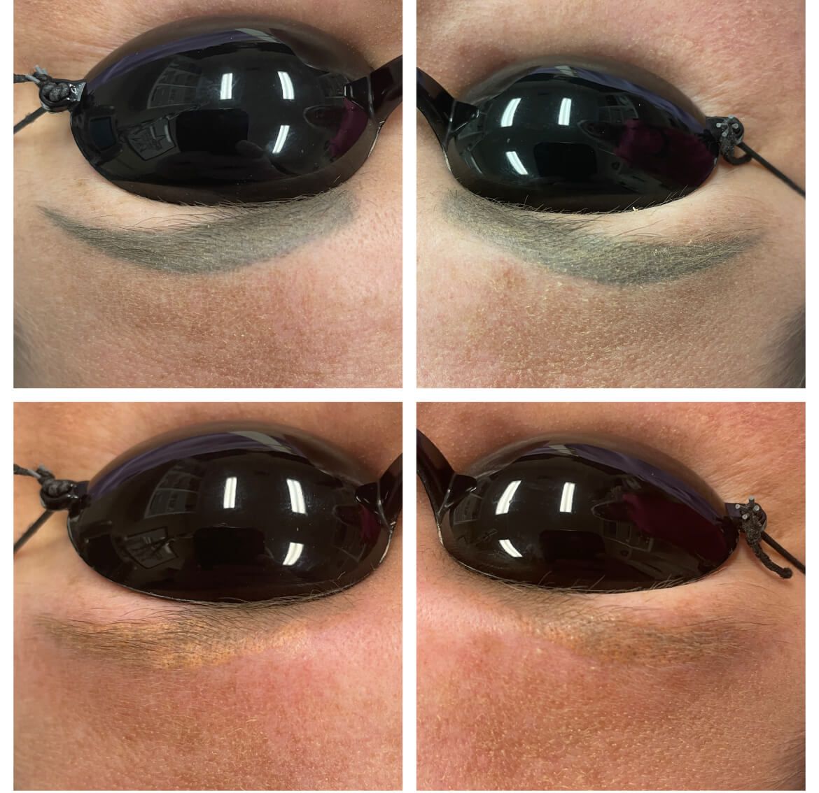 Before and after eyebrow tattoo removal.