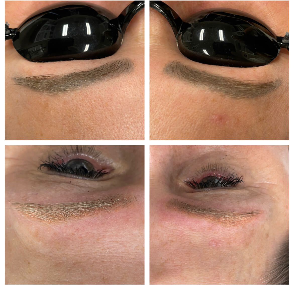 Tattooed eyebrows before and after laser removal treatment.