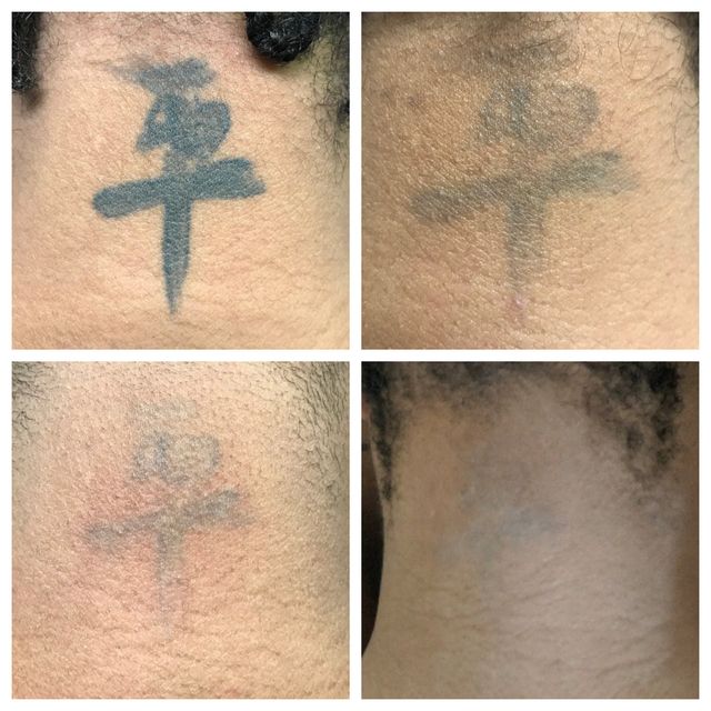 Tattoo Removal: Why Choosing The Right Provider Makes a big Difference