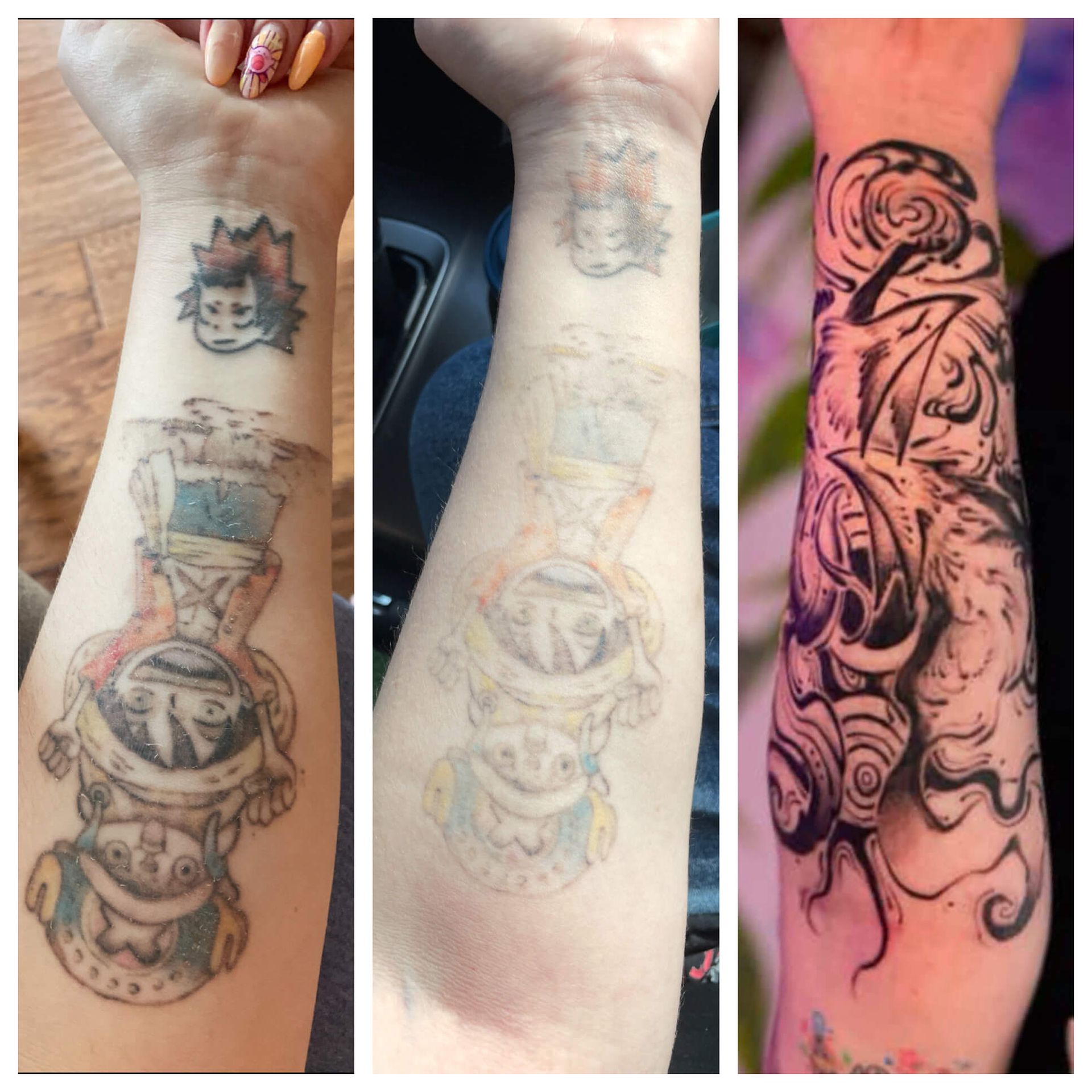 Progressive results of laser tattoo fading to prep for a new tattoo.