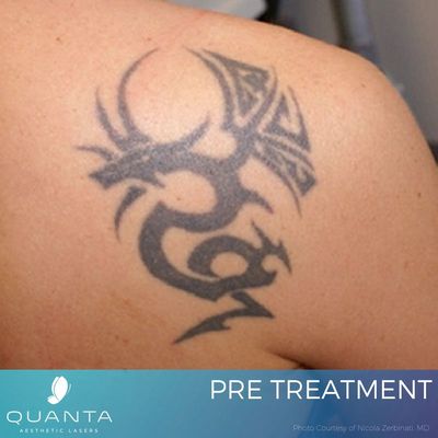 Can Laser Tattoo Removal Get Rid of My Tattoo Completely Plano - Rejuve  Med-Spa