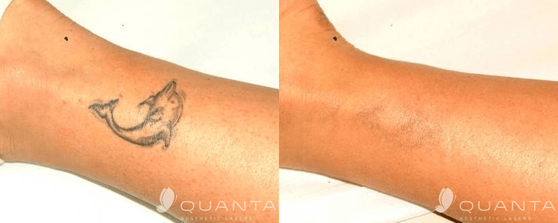 Life, Death and Laser Tattoo Removal in Dallas