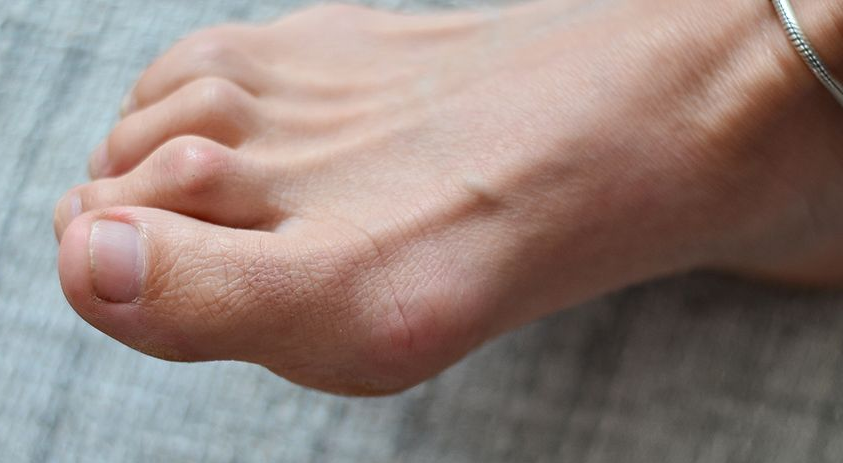 Bunions