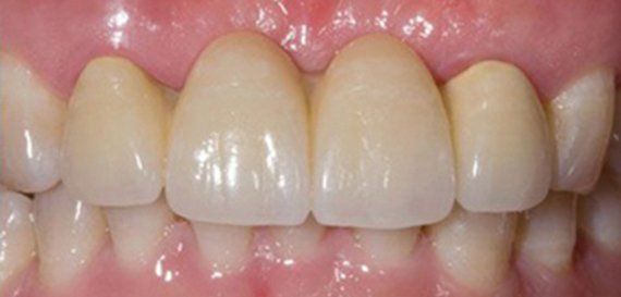 Denti mancanti sostituiti con un ponte