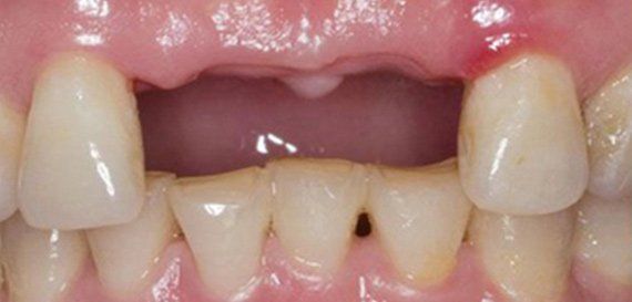 Denti mancanti sostituiti con un ponte