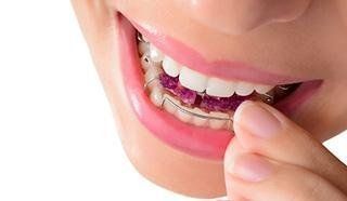 Ortodonzia invisibile