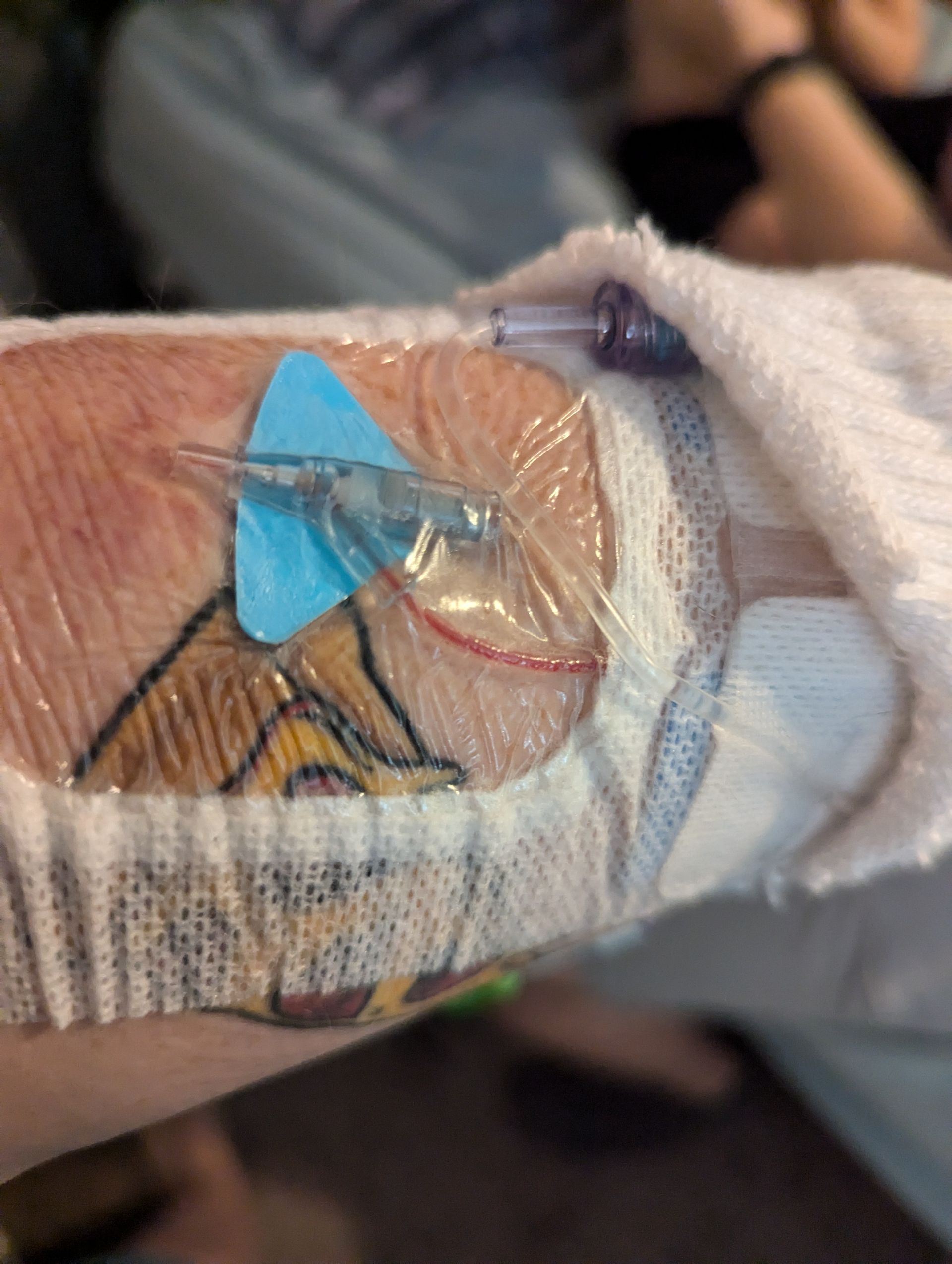 image of a failed IV for treatment of hyperemesis gravidarum