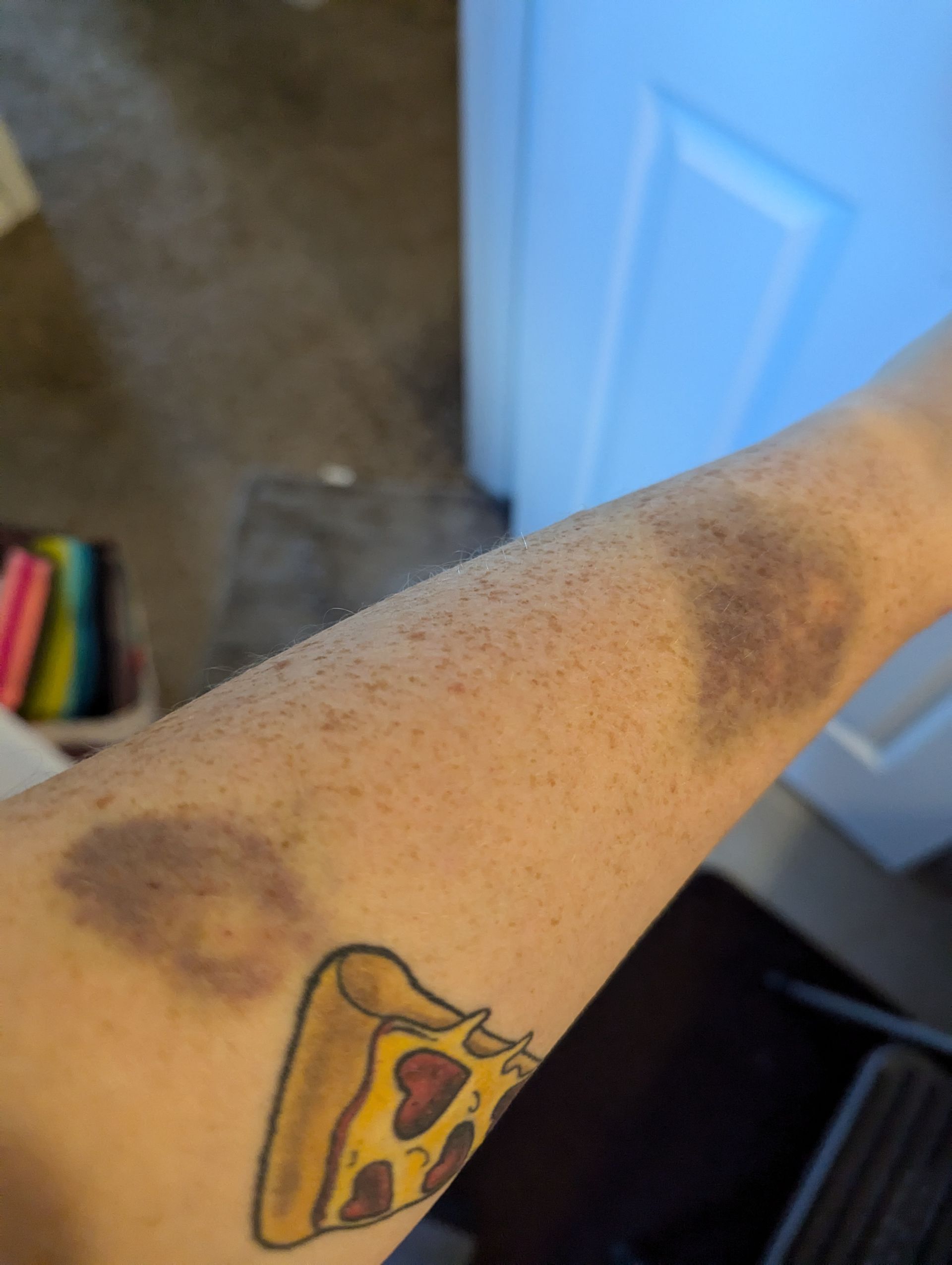 image of therapist laura ott's arm covered in bruises from failed IV lines.