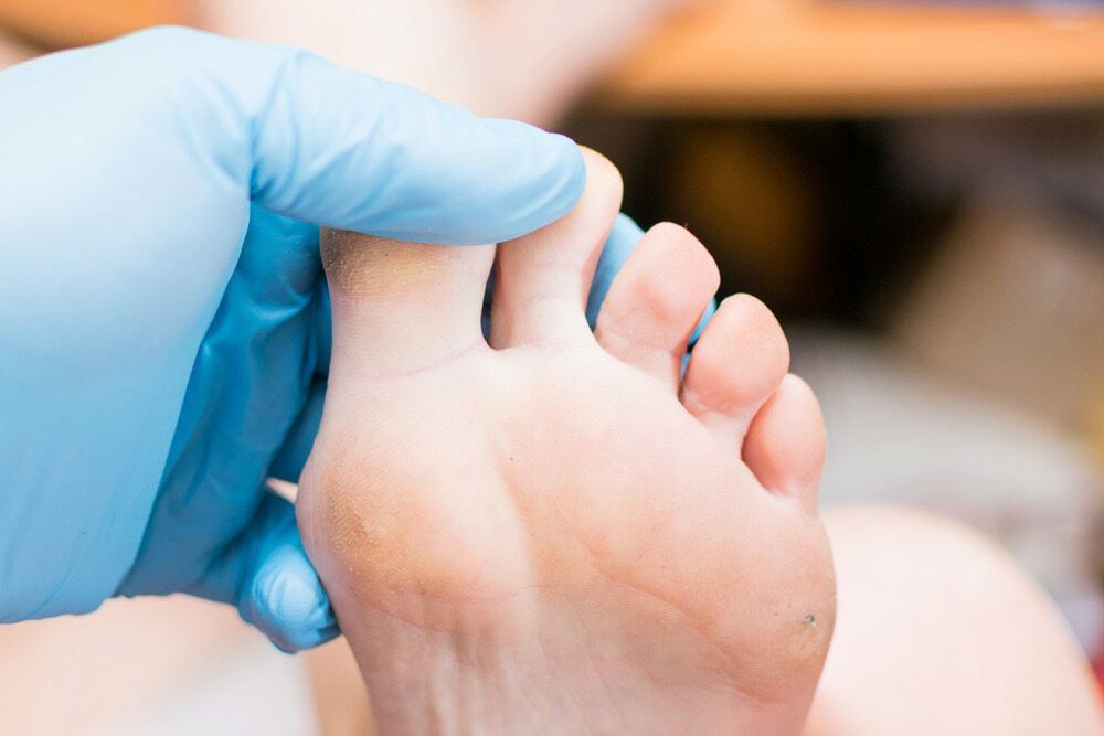 A Person Wearing Blue Gloves Is Examining A Person's Foot — Lake Macquarie Podiatry in Swansea, NSW