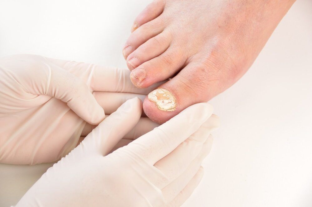 A Person Is Getting Their Toenails Examined By A Doctor — Lake Macquarie Podiatry in Belmont, NSW