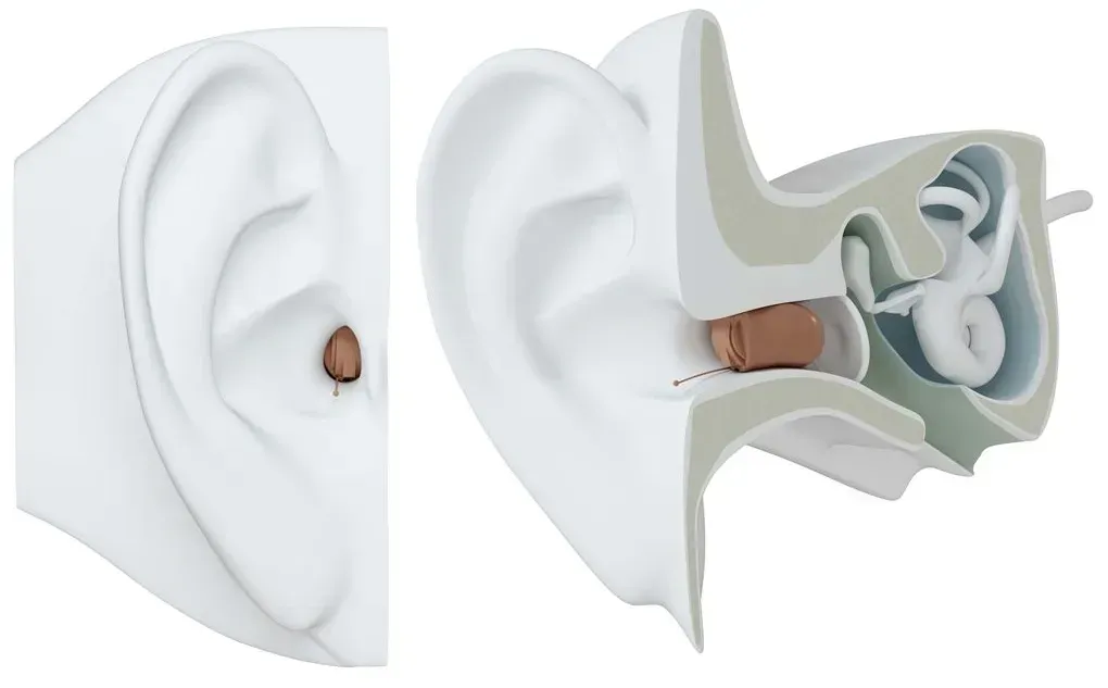 ReSound Invisible In the Ear Canal (IIC) Hearnig Aid