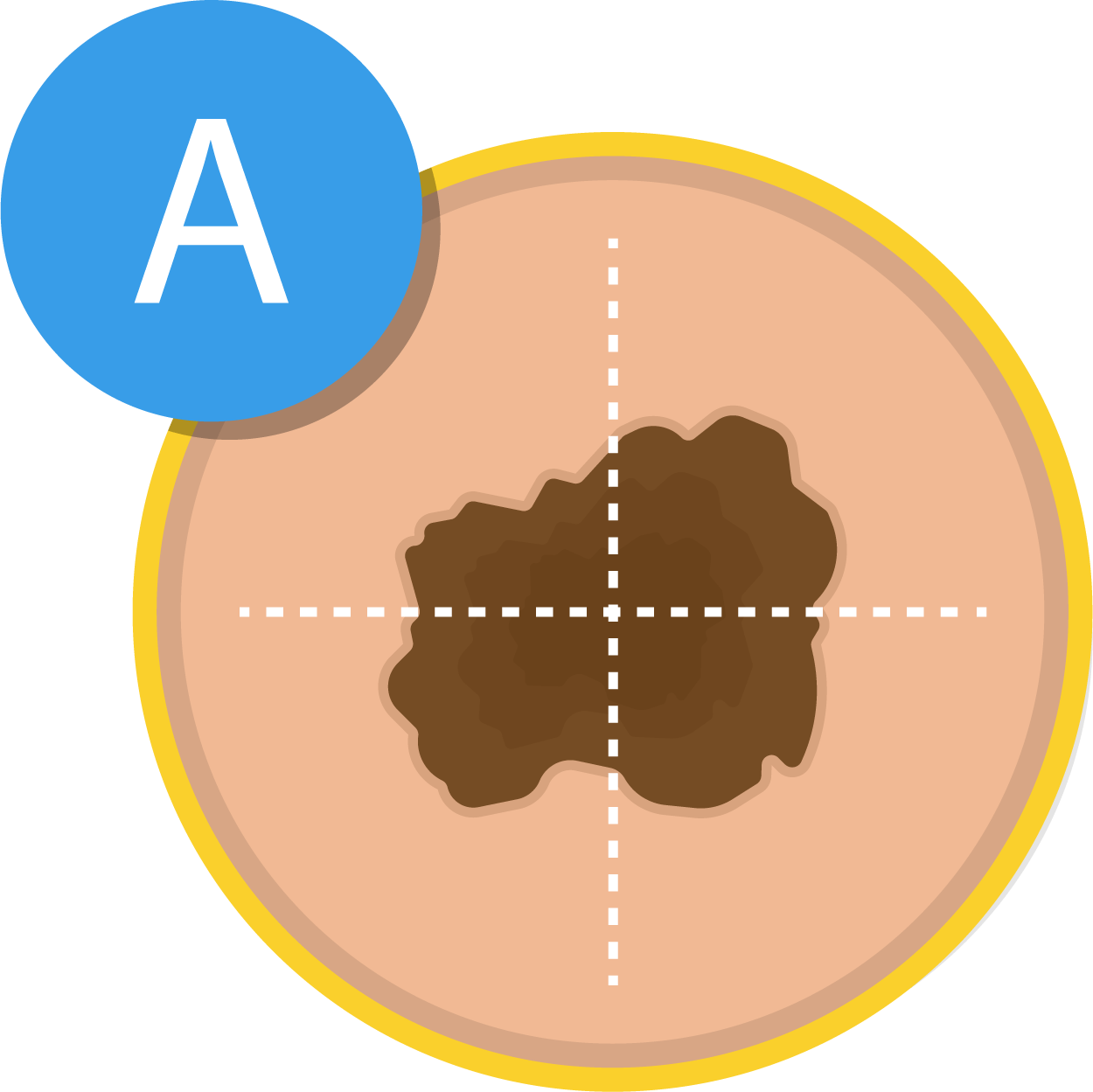 ABCDEs of melanoma