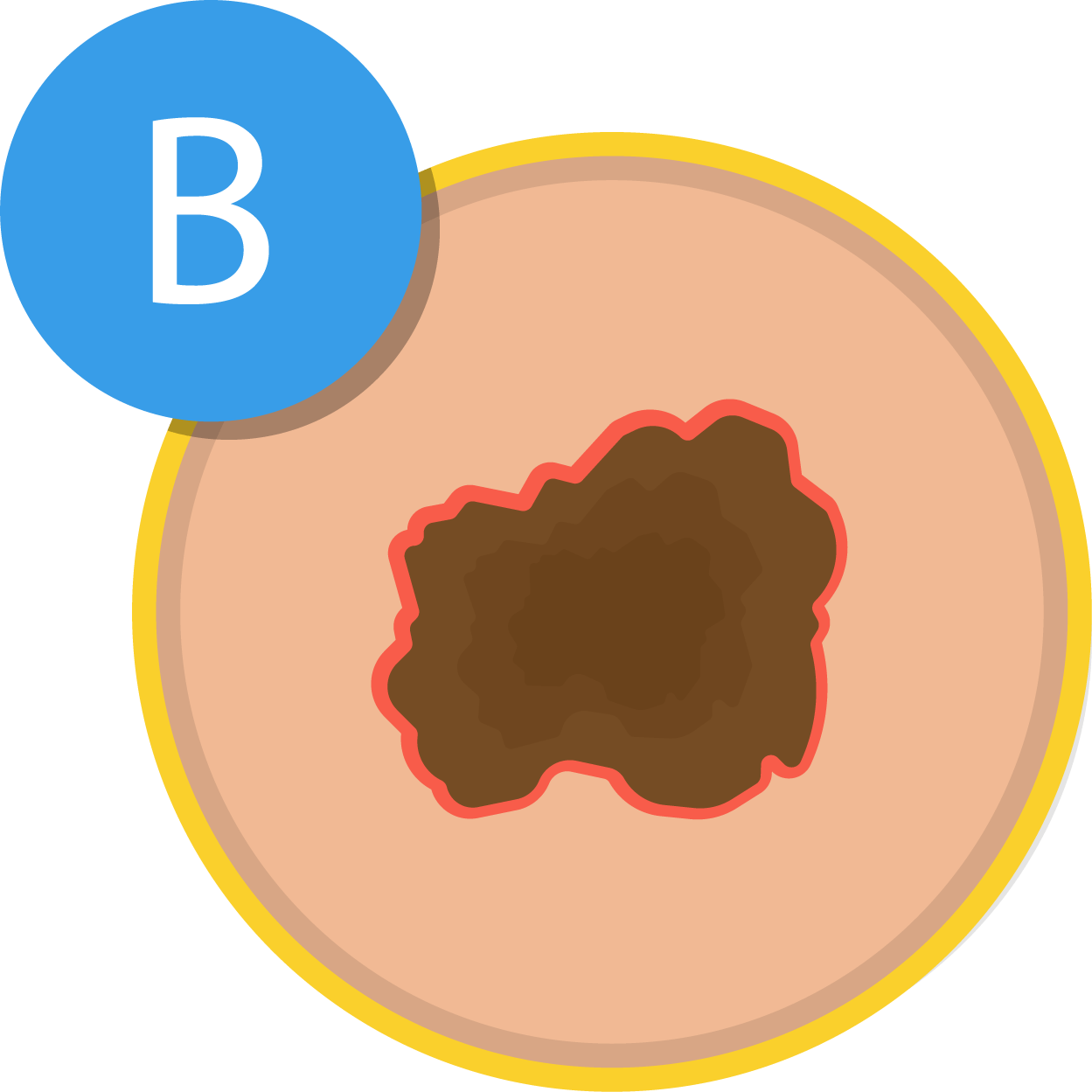 ABCDEs of melanoma