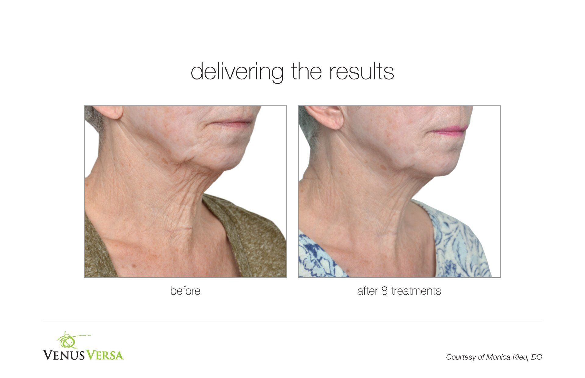 before and after photos of IPL skin tightening patient