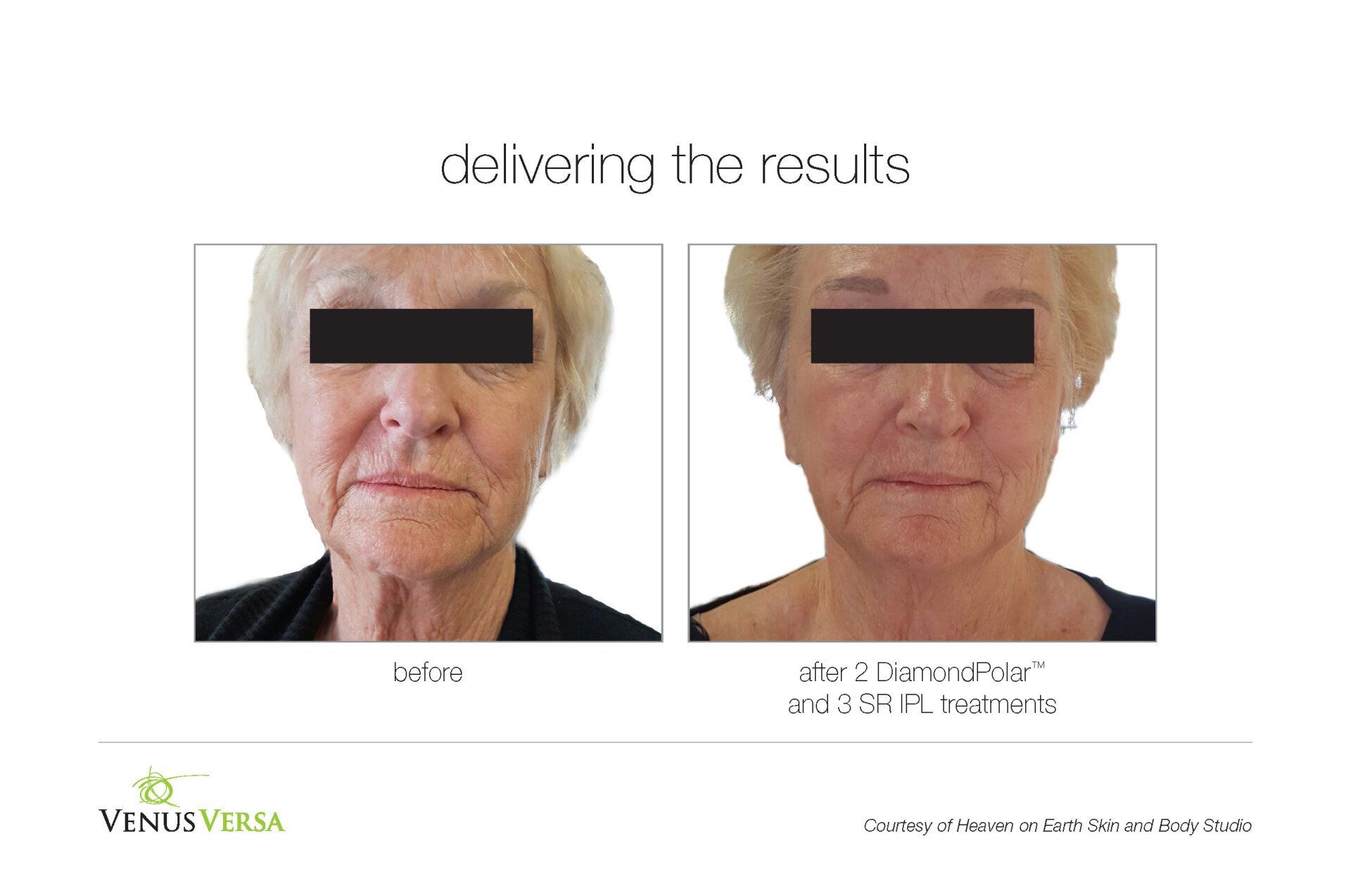 before and after photos of IPL Photorejuvenation patient