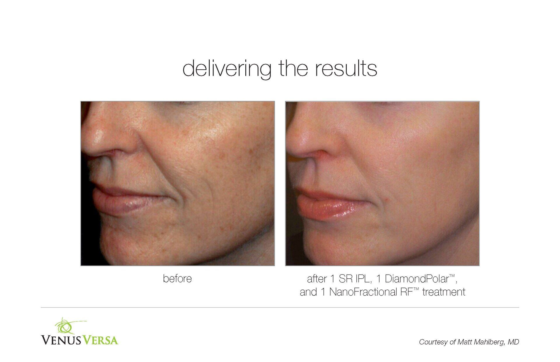 before and after photos of IPL Photorejuvenation patient