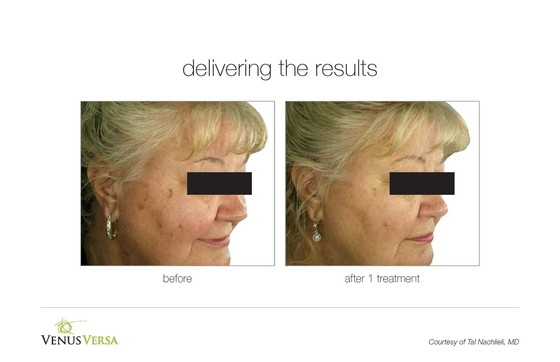 before and after photos of IPL Photorejuvenation patient