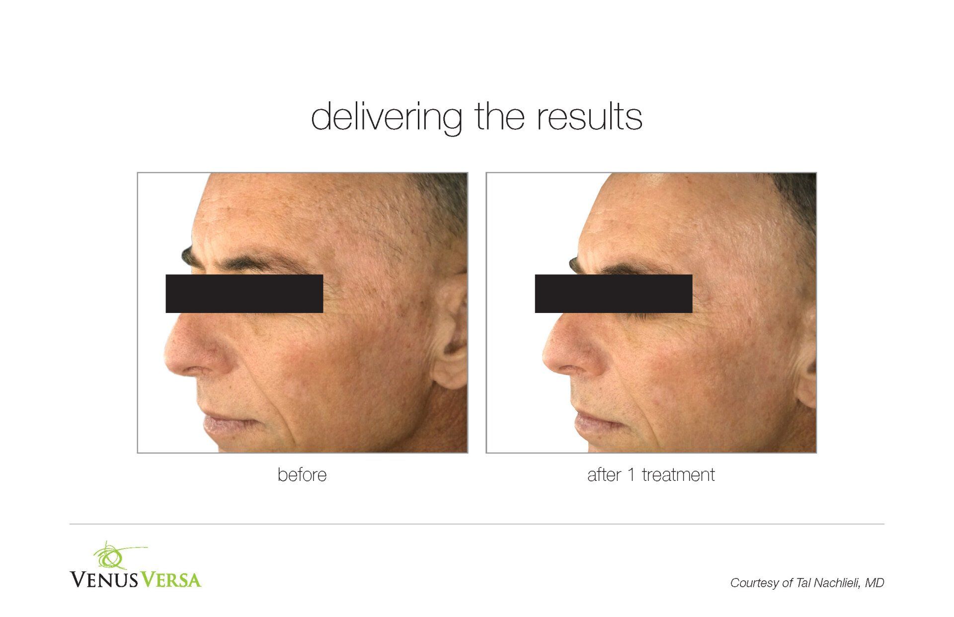 before and after photos of IPL Photorejuvenation patient