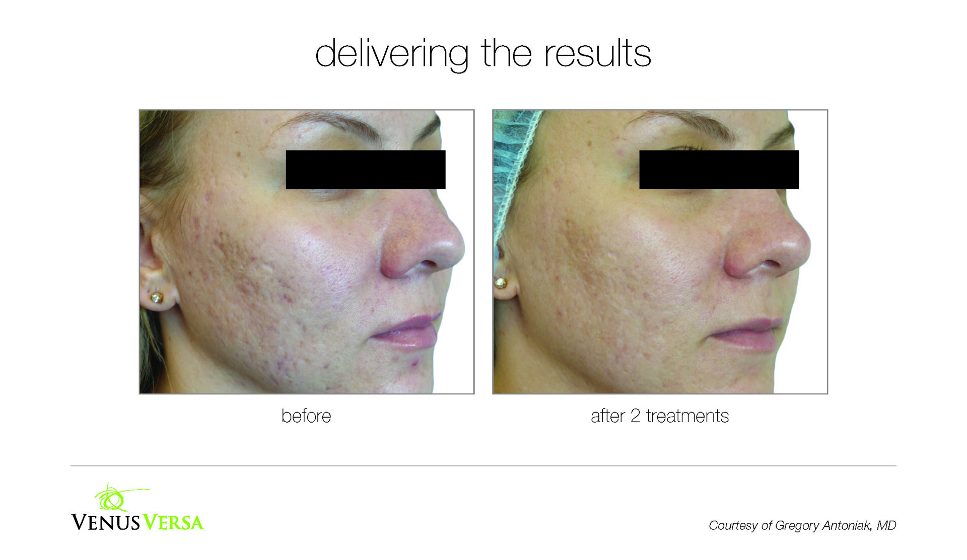 before and after photos of IPL skin revitalization patient
