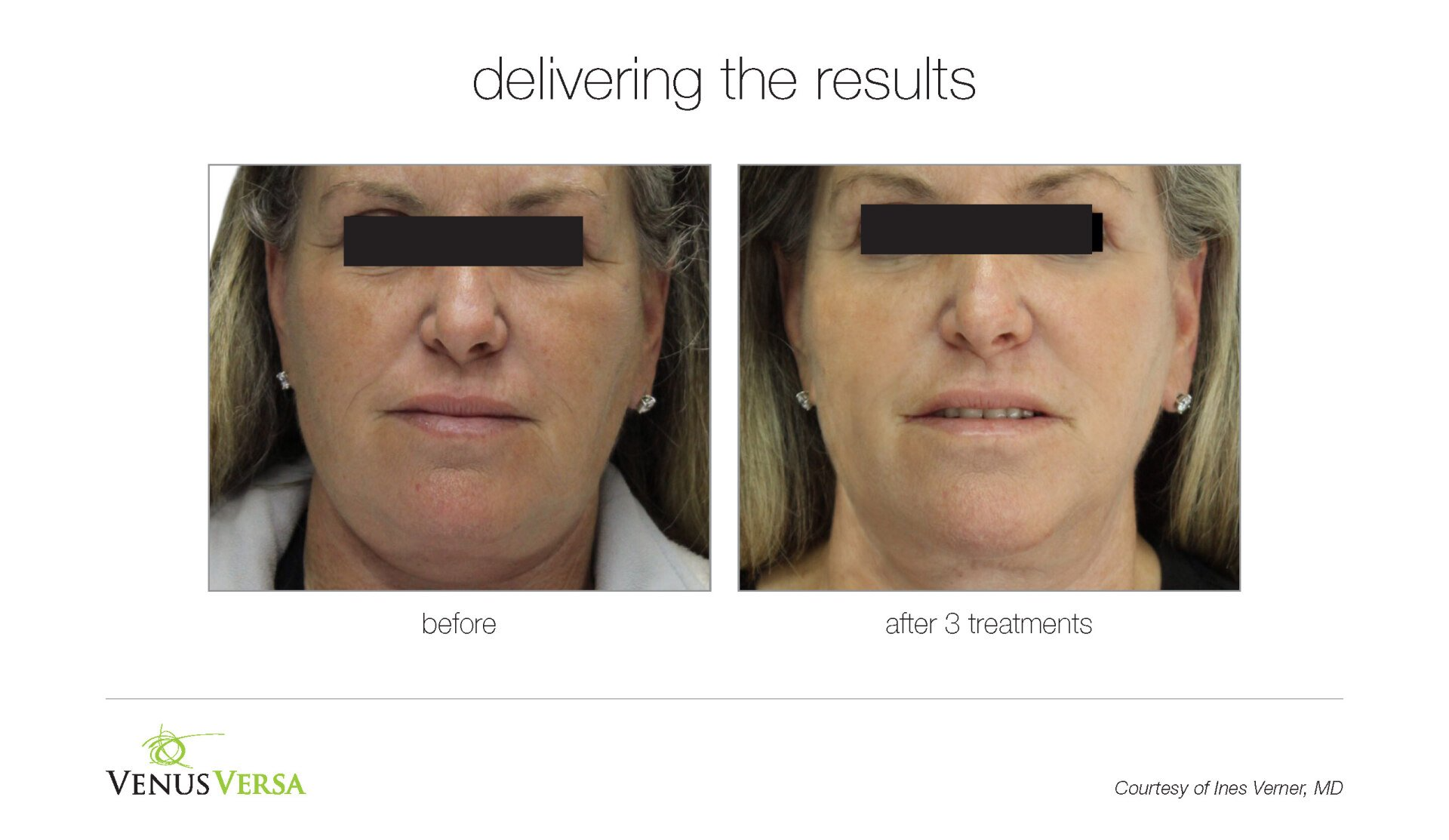 before and after photos of IPL skin revitalization patient