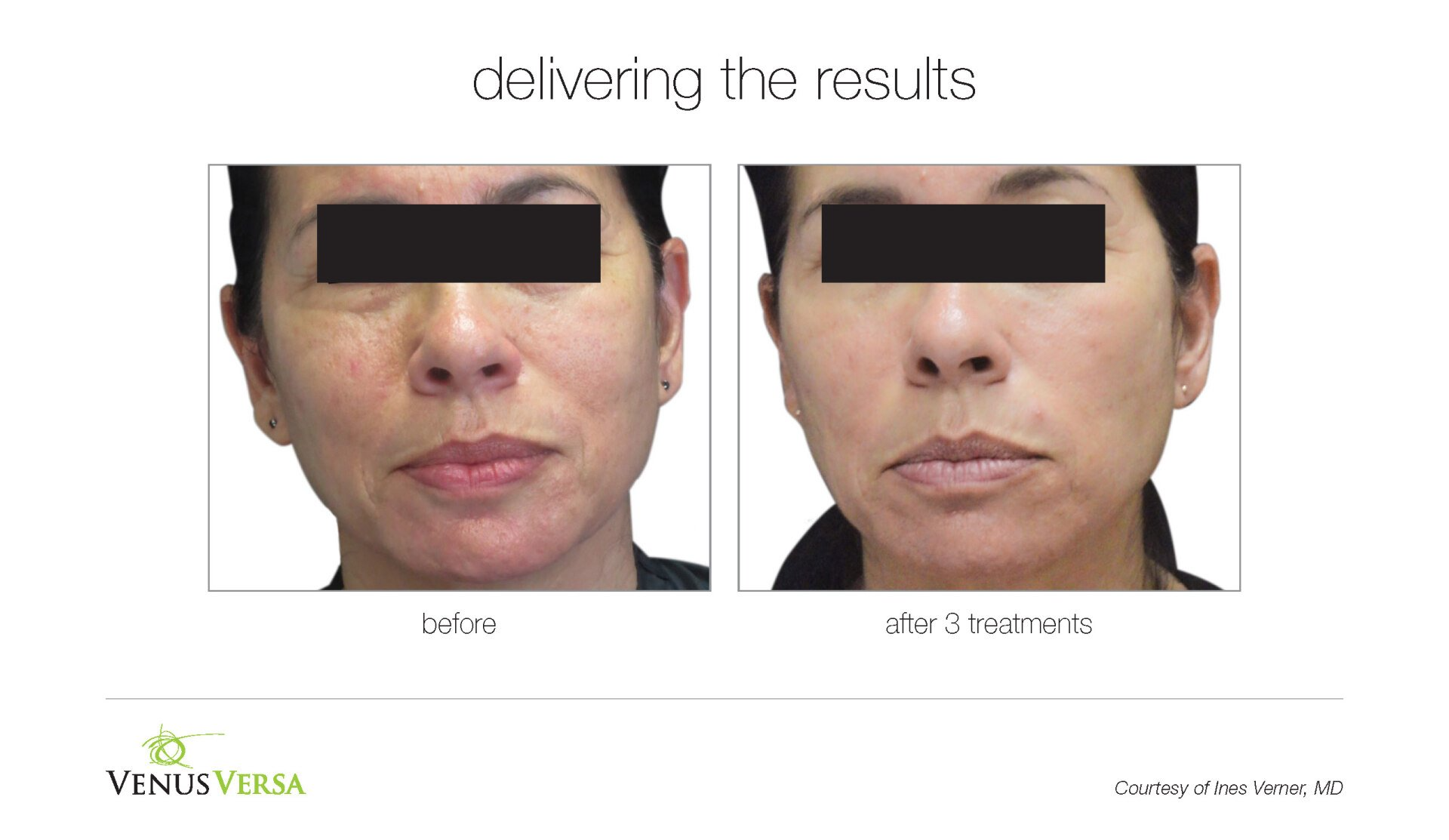 before and after photos of IPL skin revitalization patient