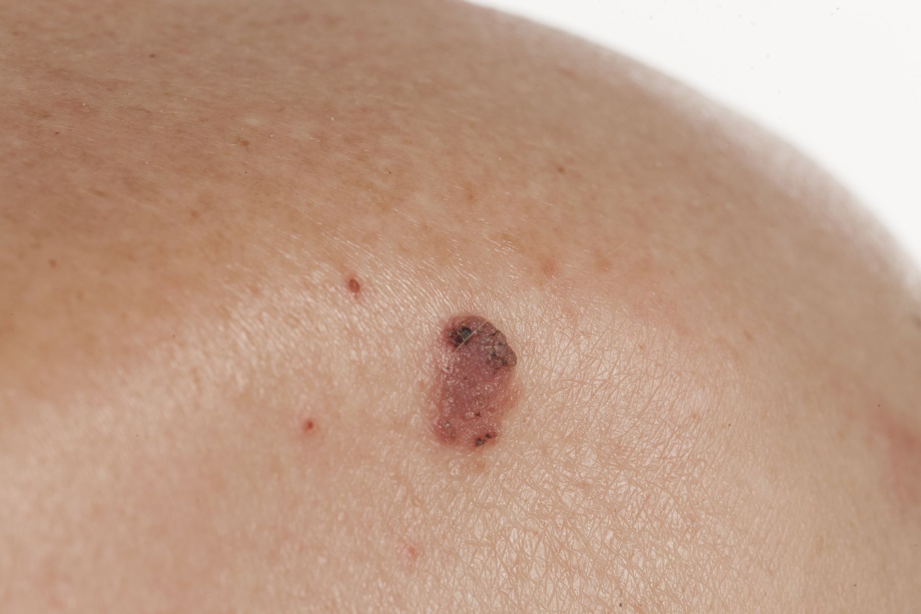 cancerous mole treated at Skin Cancer Center of Central Florida