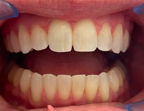 Close-up of a person's open mouth, showing a full set of white, straight teeth and pink gums.