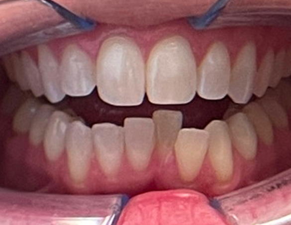 Close-up of a person's teeth. A dental retractor holds back lips, revealing healthy teeth with a slight gap.