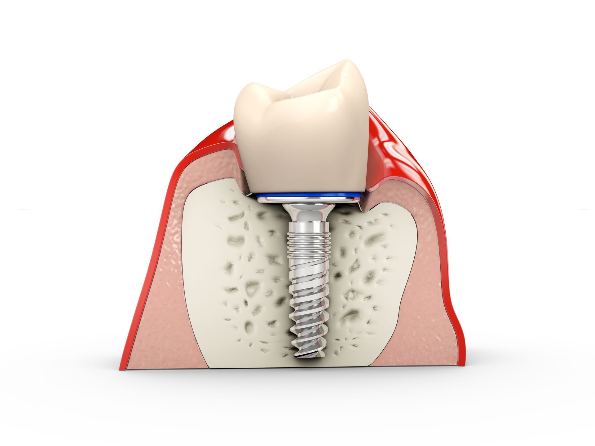 graphic model of single tooth dental implant