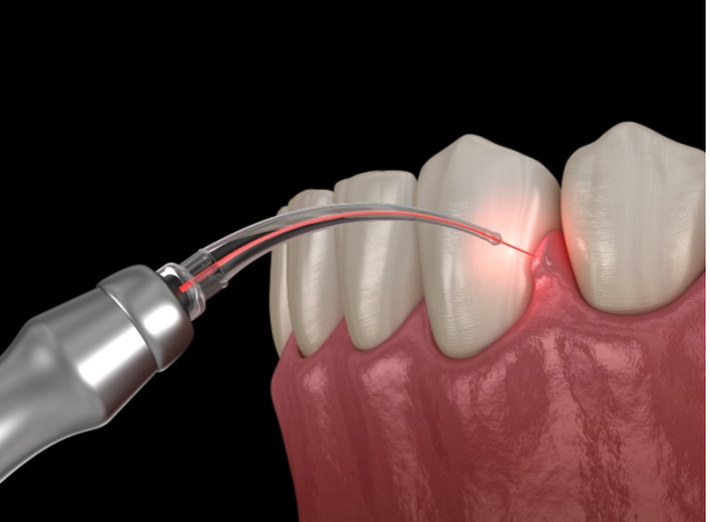 a computer generated image of a tooth being treated with a laser.
