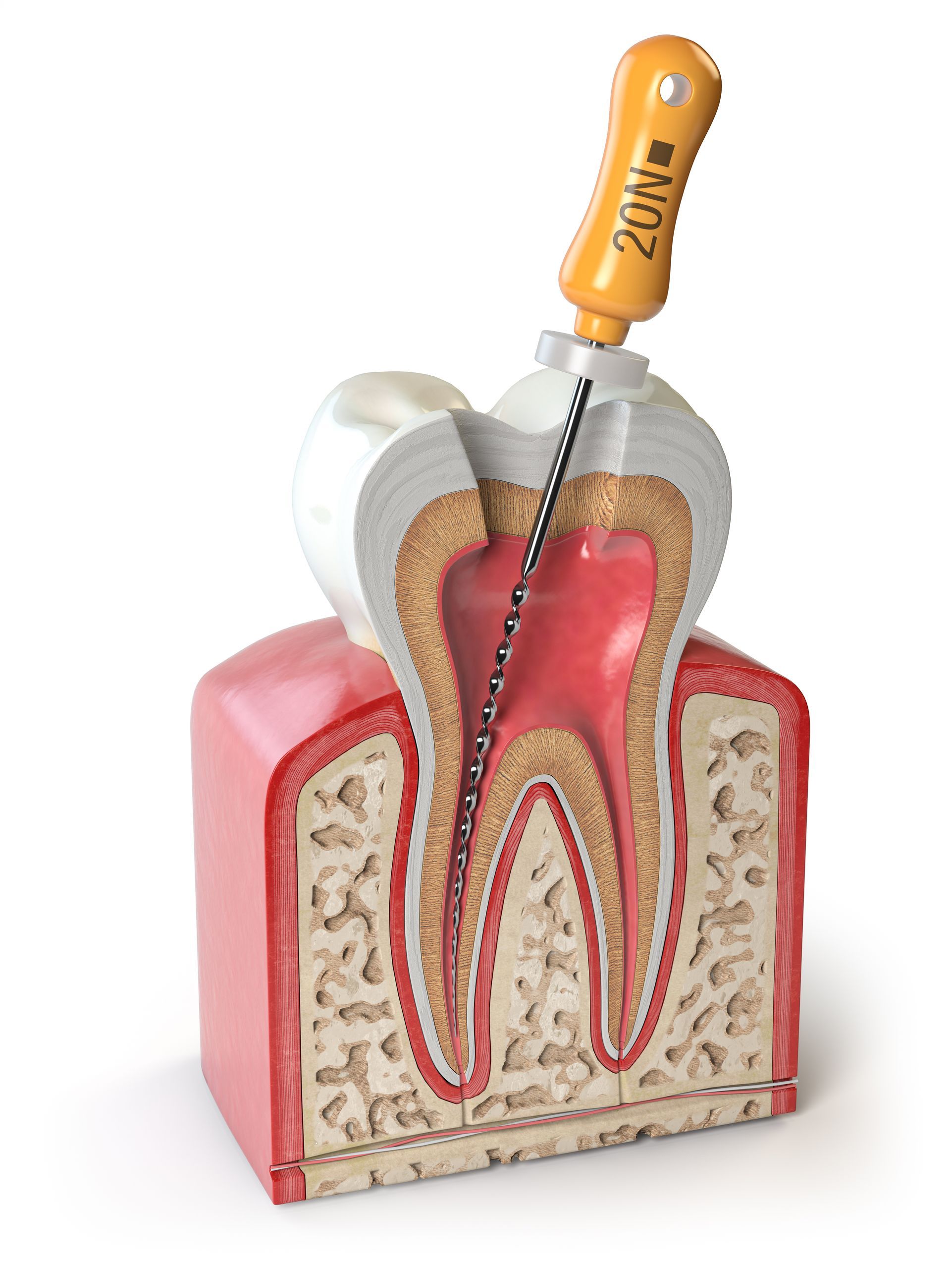 graphic model of single tooth root canal procedure