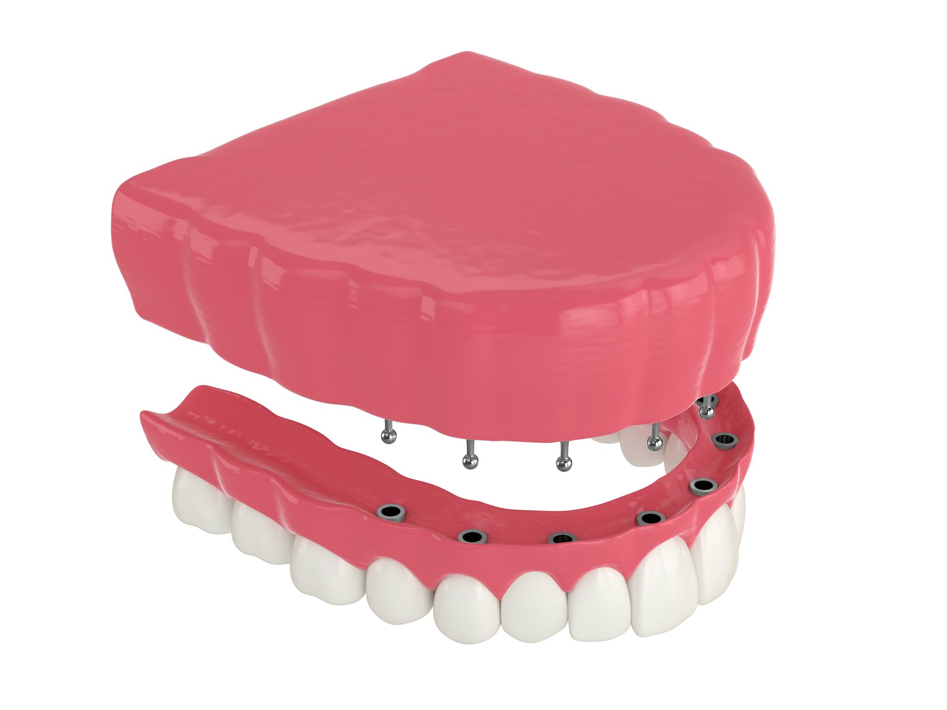 graphic model of snap-on dental implant dentures