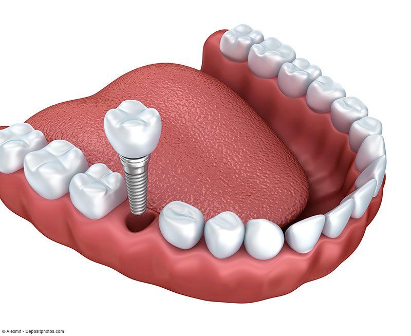 Ersatz eines einzelnen Zahnes durch ein Zahnimplantat