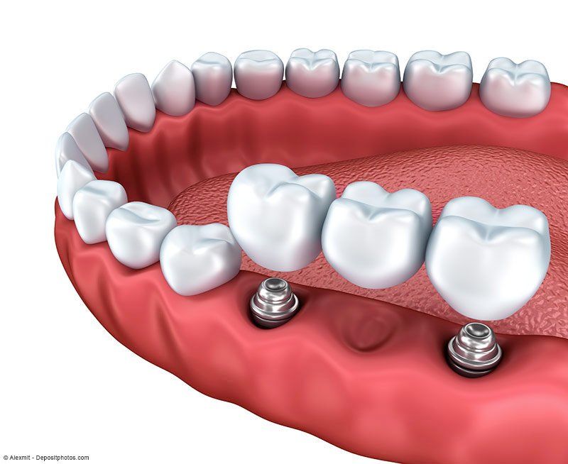 Ersatz mehrer Zähne durch eine implantatgetragene Zahnbrücke