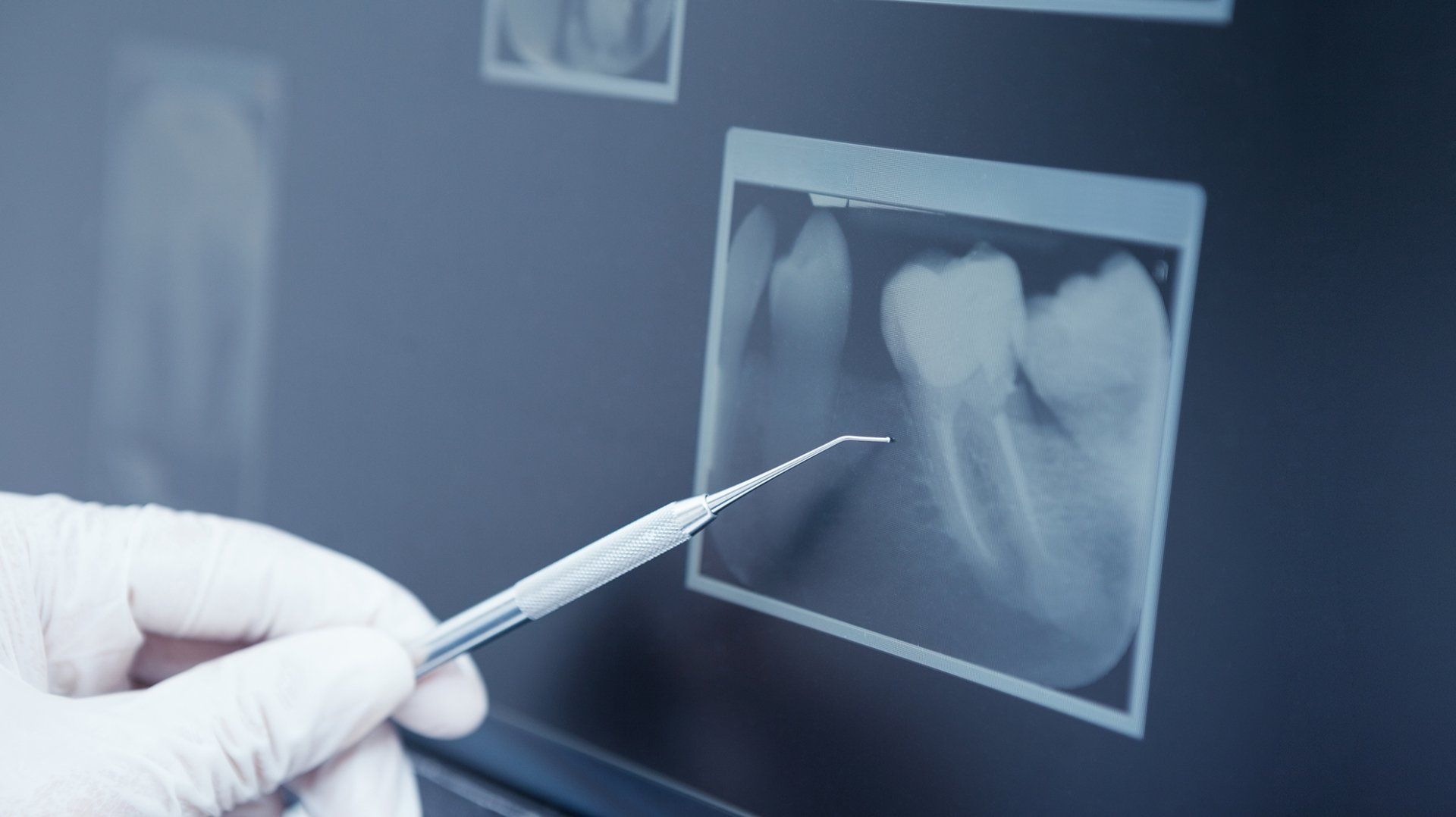 Wurzelbehandlung in Höhr-Grenzhausen bei Koblenz