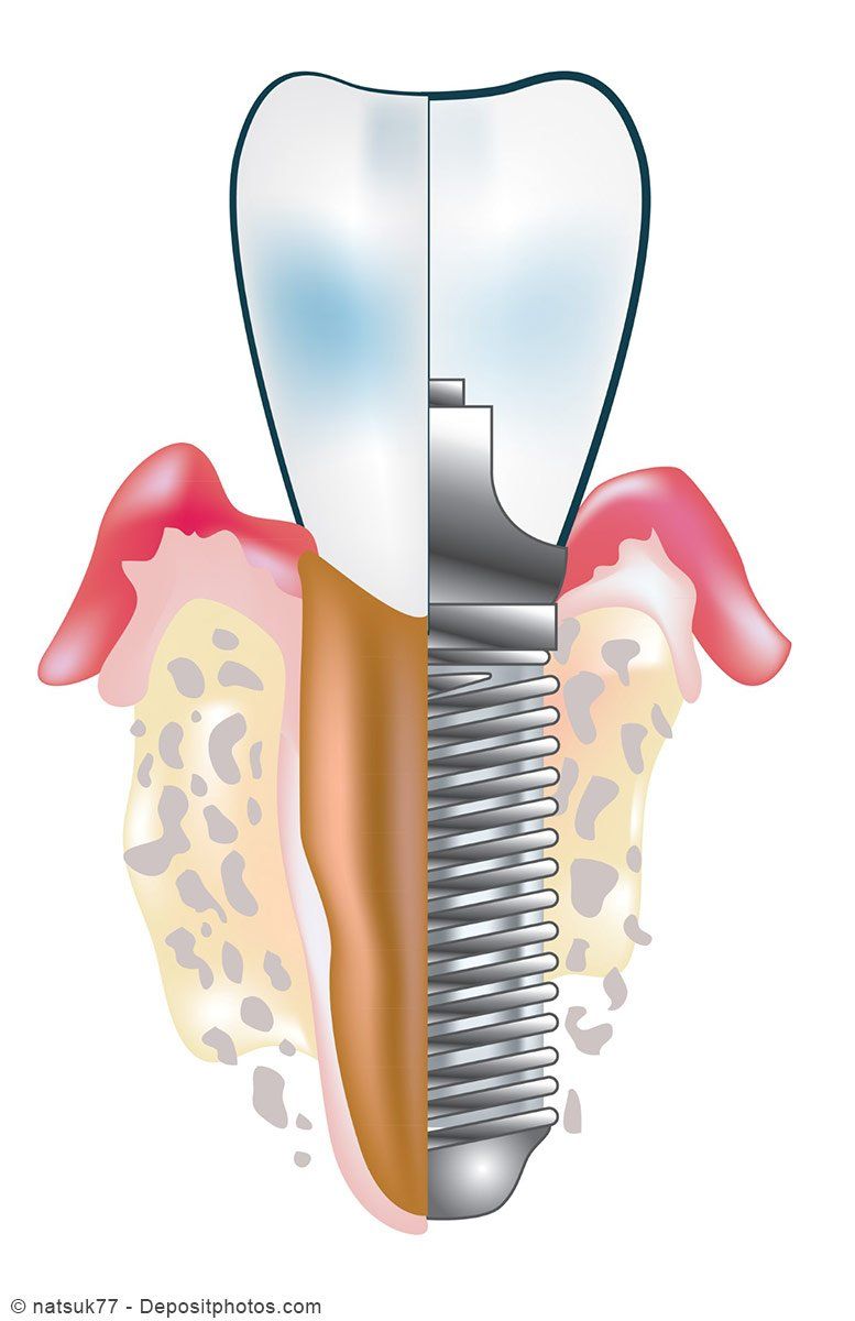 Vergleich Aufbau Zahn zu Zahn-Implantat