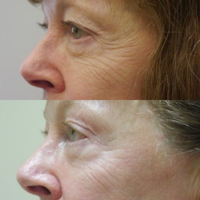 Transformation Aesthetic Solutions Tempsure Envi Wrinkle Reduction