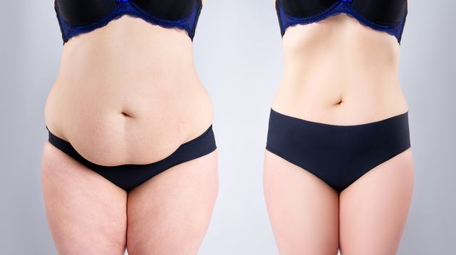 Transformation Aesthetic Solutions | Tummy Tuck | Stomach Tightening