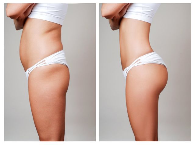 Transformation Aesthetic Solutions | Liposuction | Body Sculpting