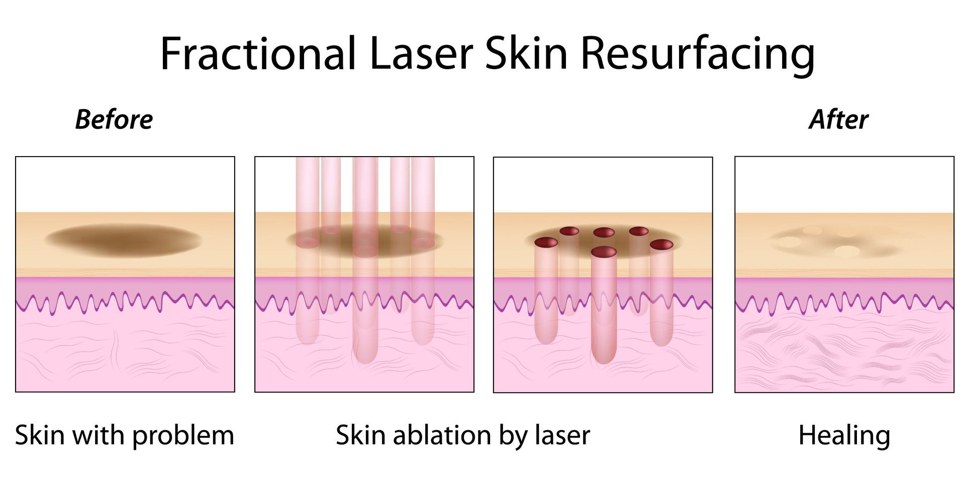 transformation aesthetic solutions, plastic surgery center, medical spa, Erbium Laser, Skin Resurfacing, Wrinkle Reduction, Skin Rejuvenation