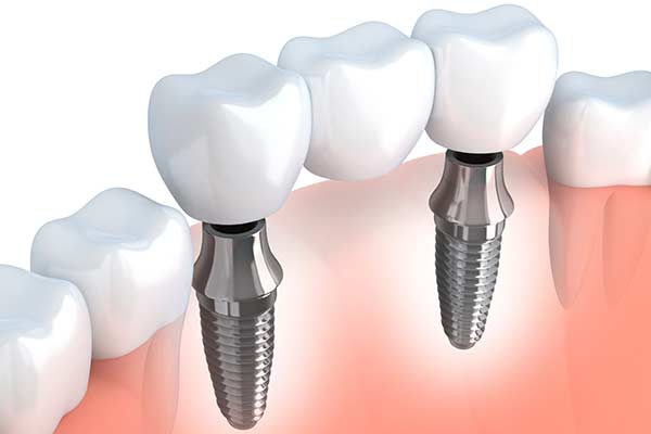 Modern Dental Implants