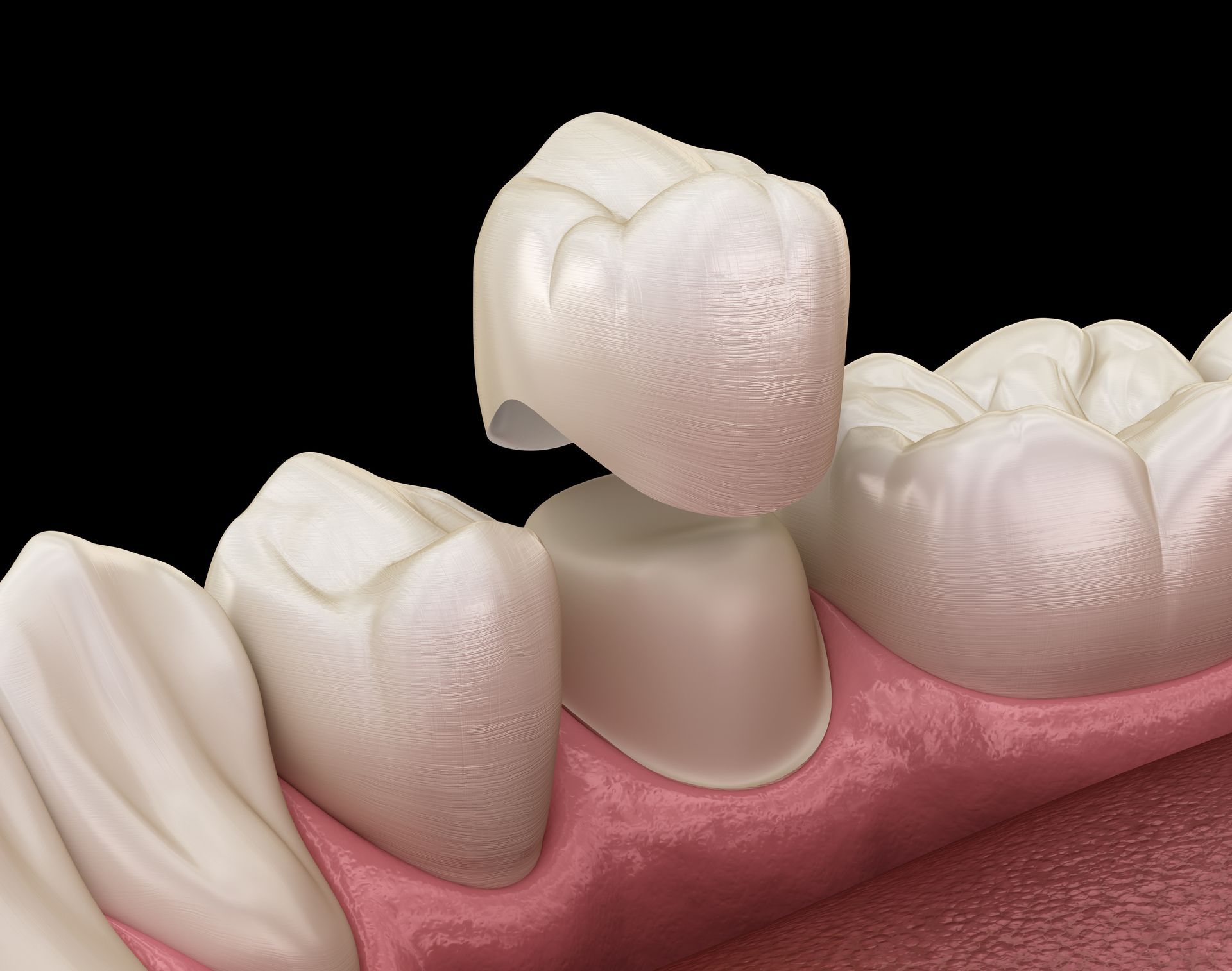 A porcelain dental crown being lowered onto a prepared tooth with surrounding teeth and gums