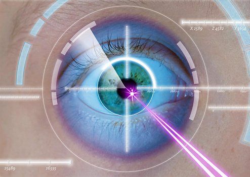Trattamento laser della cornea