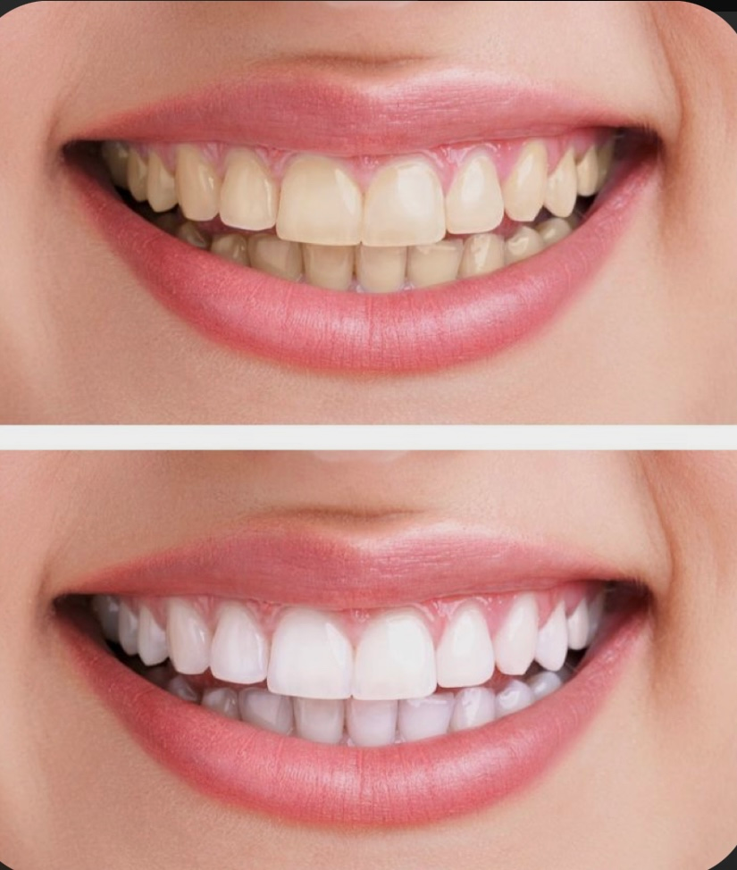 A before and after picture of a woman 's teeth