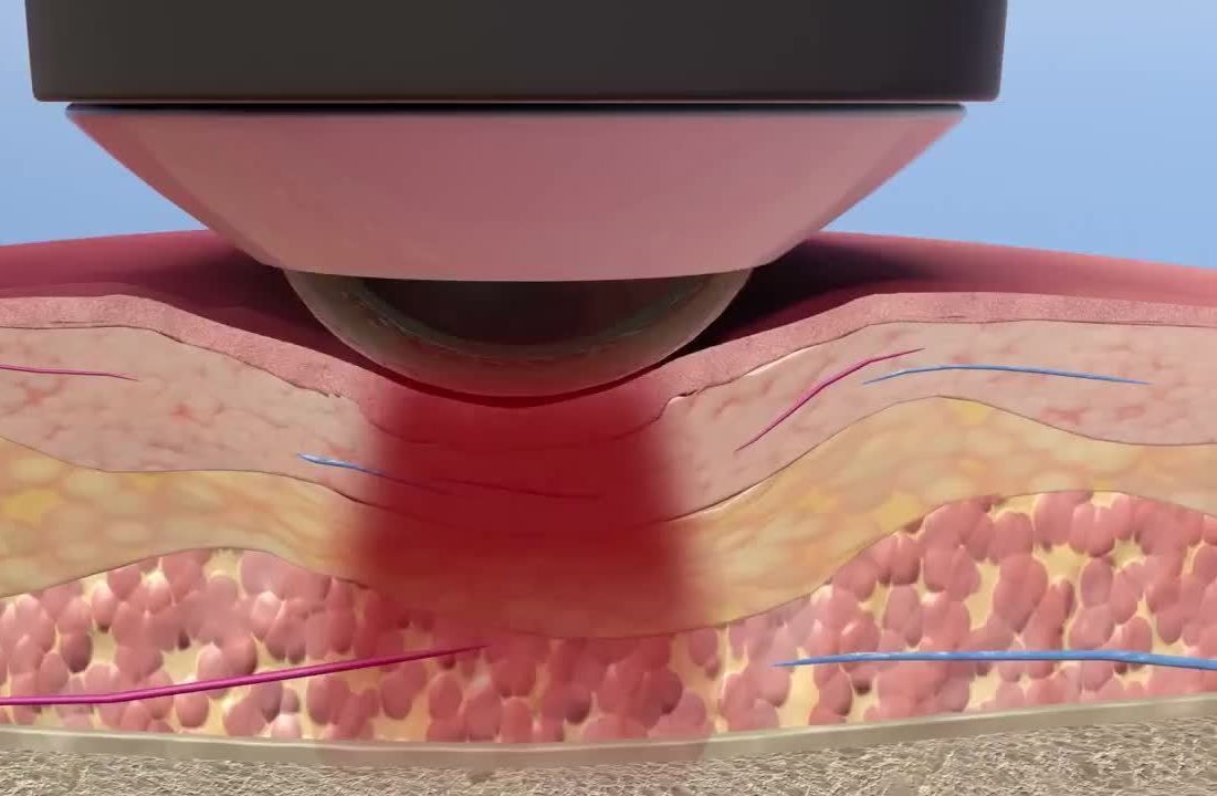 Animation of deep tissue laser therapy