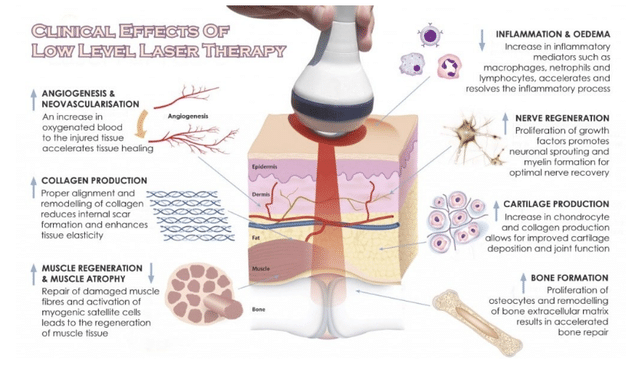 a sheet explaining the benefits of medical laser treatment
