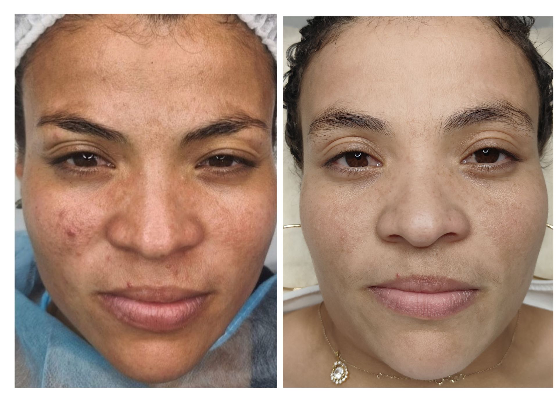 Before and after results of Bio Microneedling