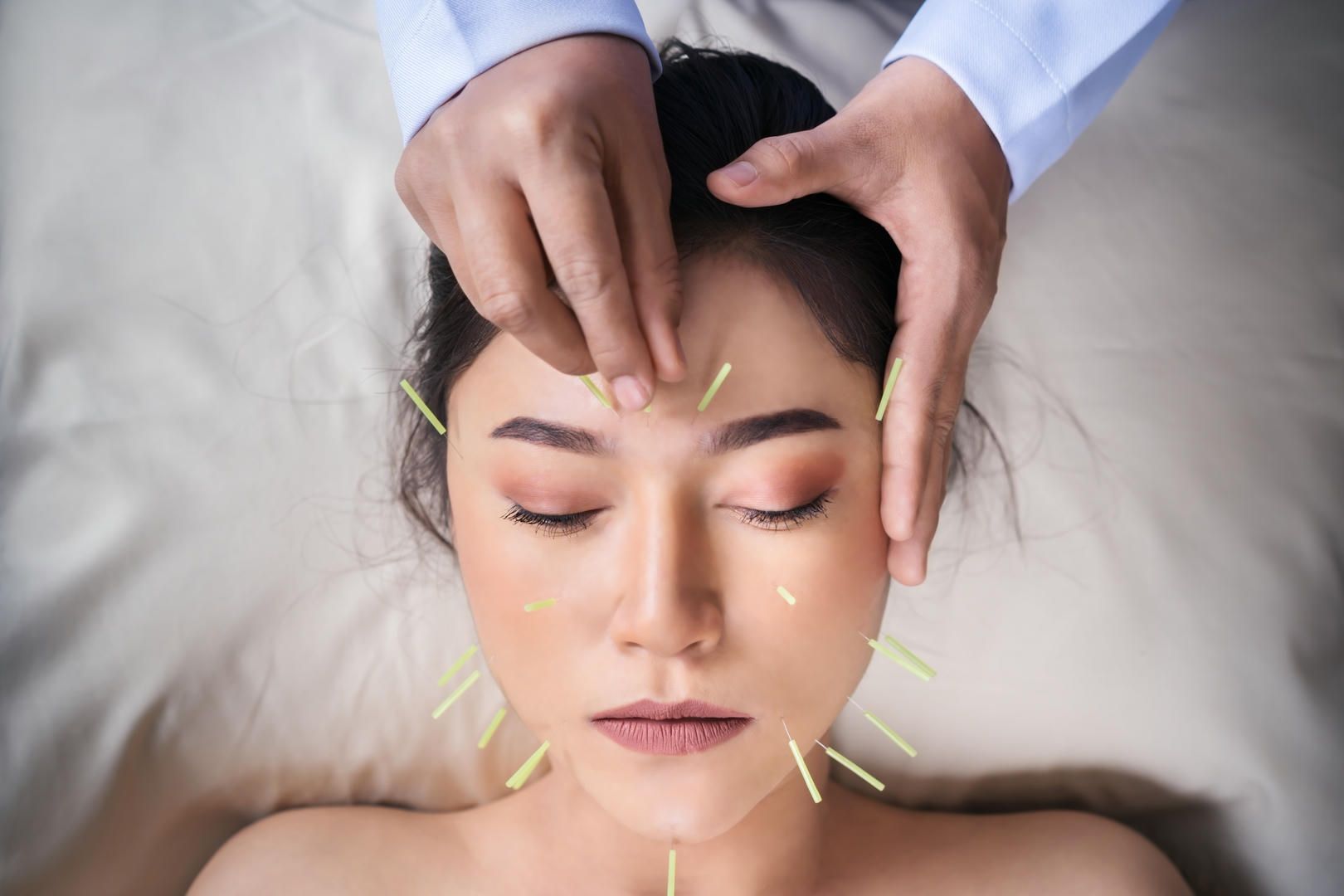 A woman is getting acupuncture treatment on her face.